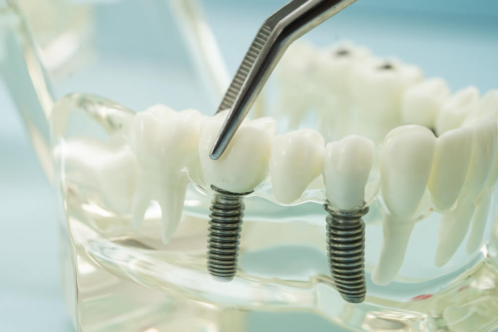 Dental Implants: A Long-Term Solution for Missing Teeth